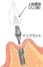 インプラントの説明