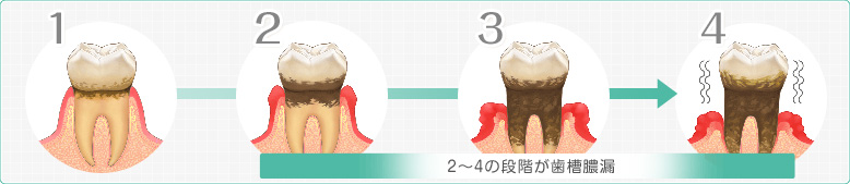 歯周病の進み方